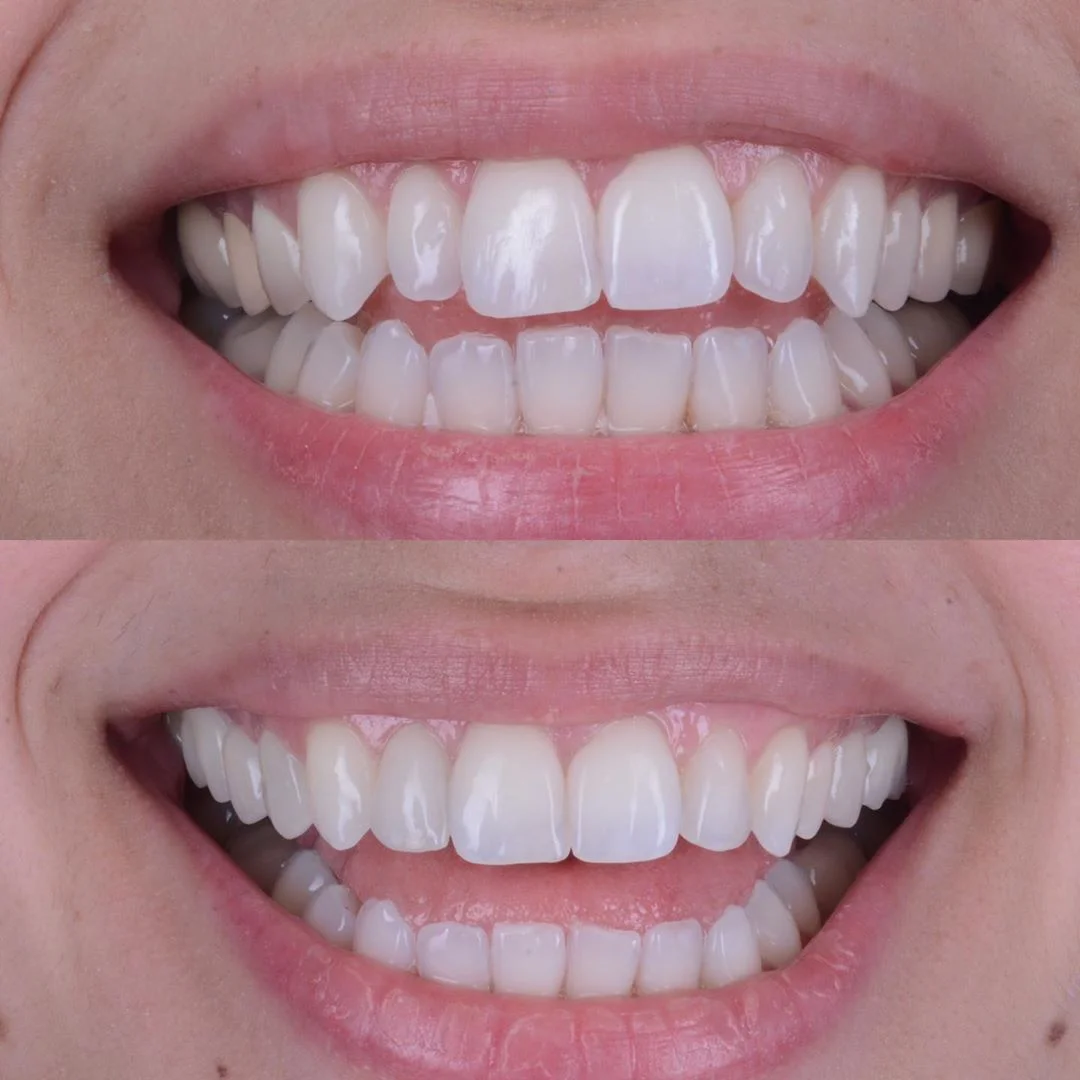 Ekonomik Gülüş Tasarımı: Lamine Alternatifi Bonding