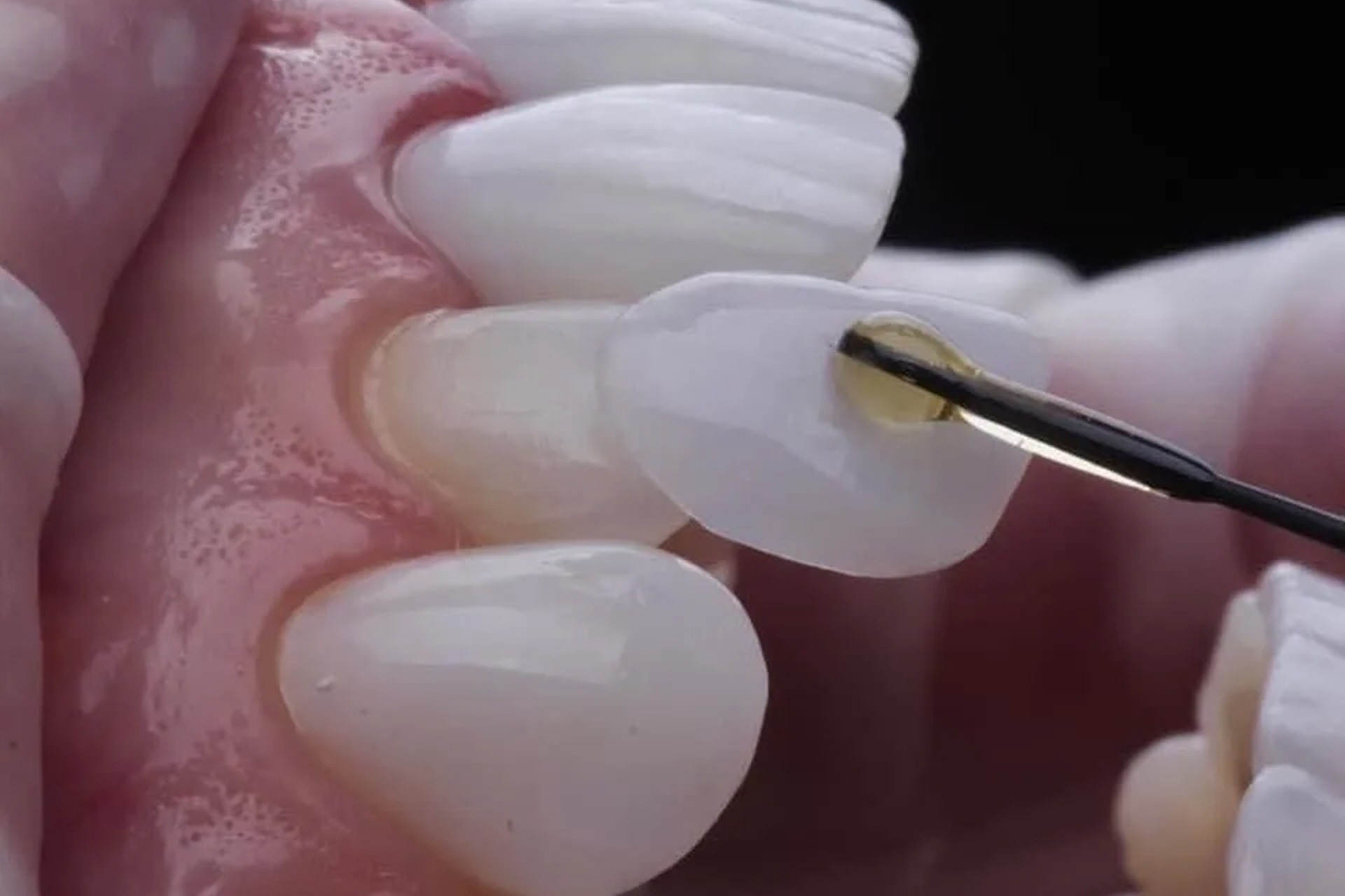 No-Prep Lamine (Sıfır Kesim): Kimler Gerçekten Bu İşlem İçin Uygundur?