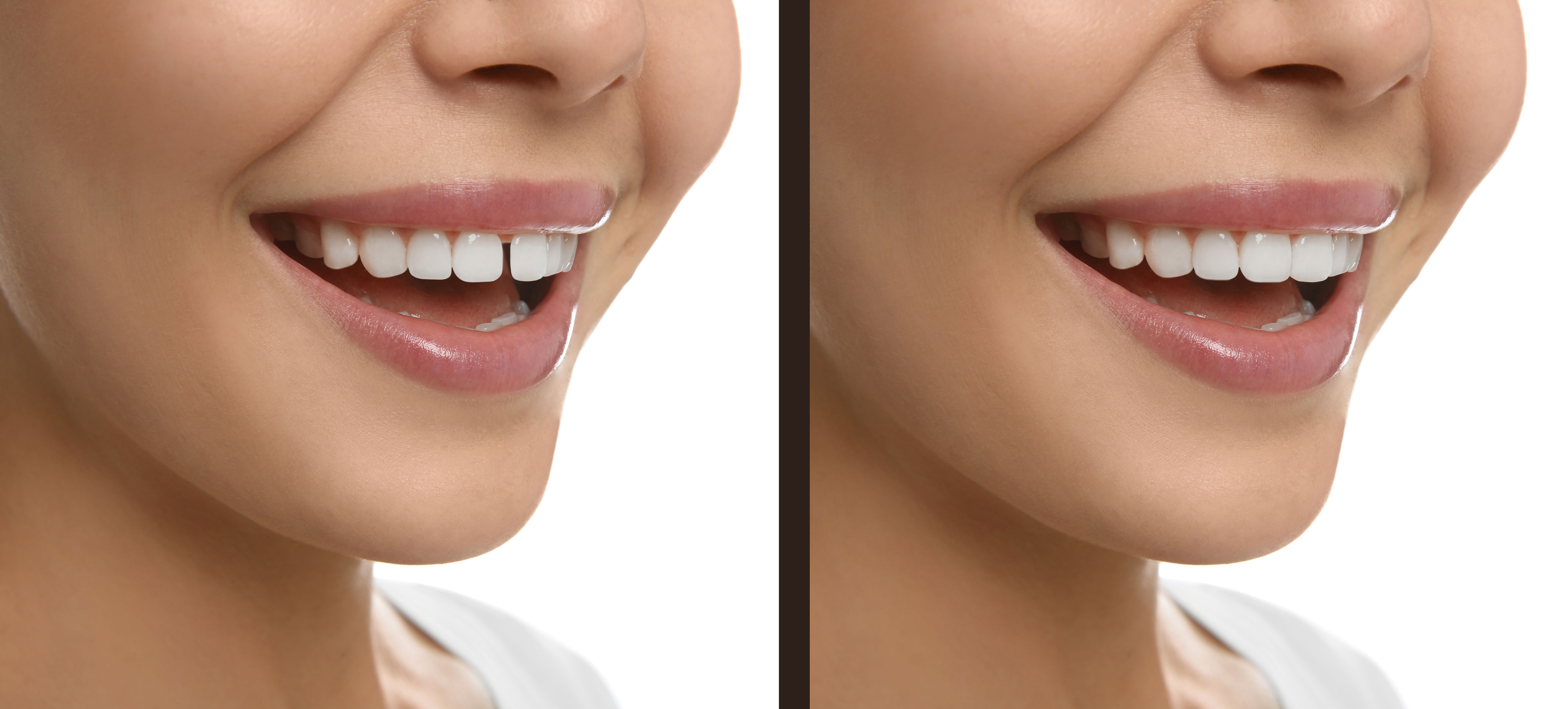 Ayrık Dişler (Diastema) İçin En Hızlı Çözüm: Tek Seansta Bonding Mucizesi