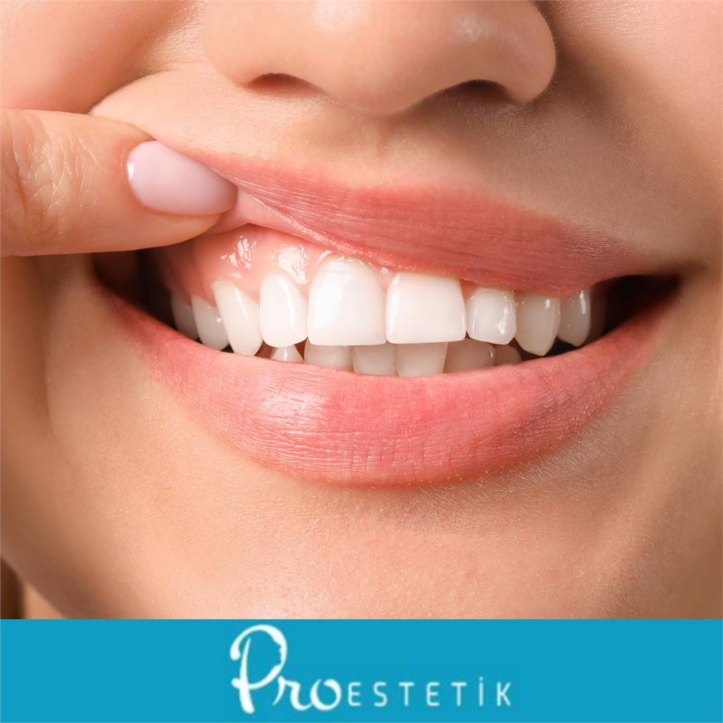 Diş Eti Şekillendirme (Gingivoplasti) Nedir, Kimlere Uygulanır?