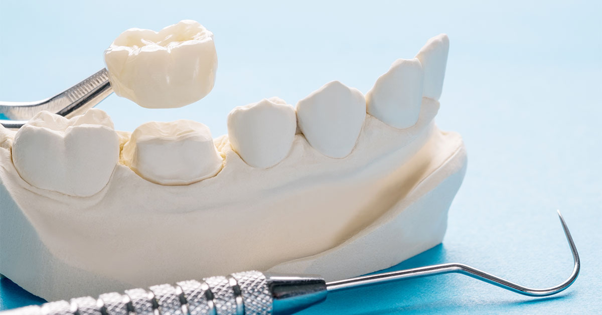 Geçici Kaplama Dönemi: Zirkonyumlar Hazırlanırken Konforunuzdan Ödün Vermeyin