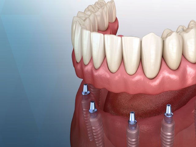 İmplant Üstü Hareketli Protezler (Overdenture): Tam Damak Kullananlar İçin Sabitleme Rehberi