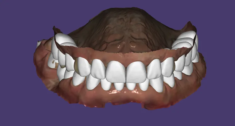 Dijital Prova (Mock-up) Yanıltır mı? Provadaki Gülüşün Birebir Kopyalanması