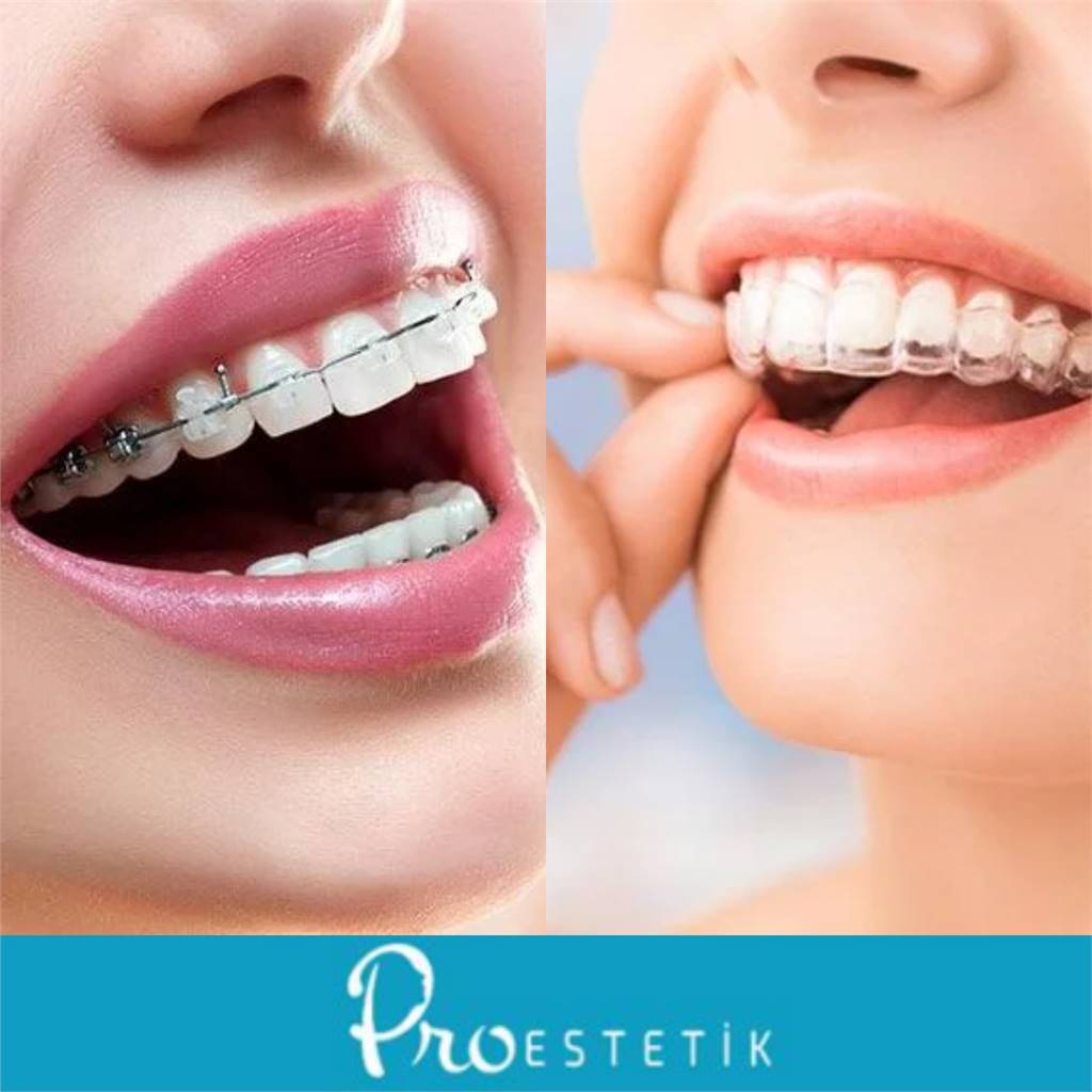 Şeffaf Plaklar mı, Klasik Braketler mi? Karar Verme Rehberi