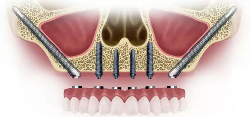 Zygomatik (Elmacık Kemiği) İmplantlar: Üst Çene Kemiği Tamamen Erimiş Hastalar İçin Son Çare