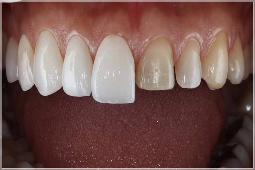 Alerjik Bünyeler İçin Diş Eti Dostu: Zirkonyumun Biyouyumlu Yüzey Yapısı